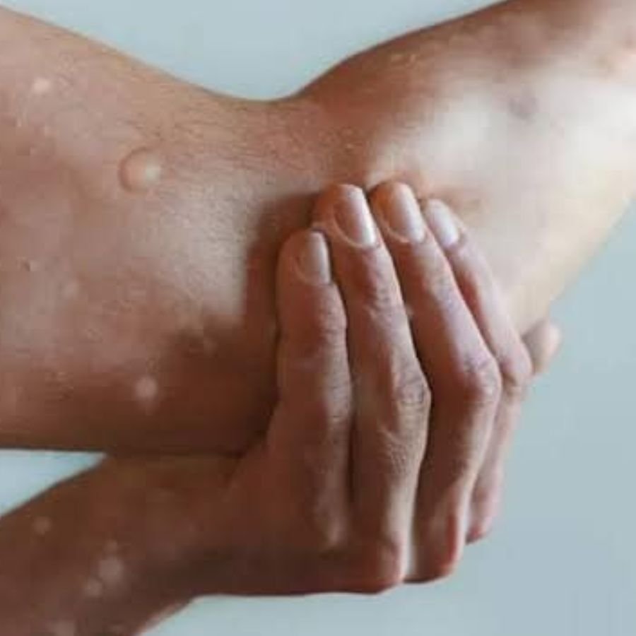 Por viruela del mono inicia capacitación a personal de Salud en Solidaridad